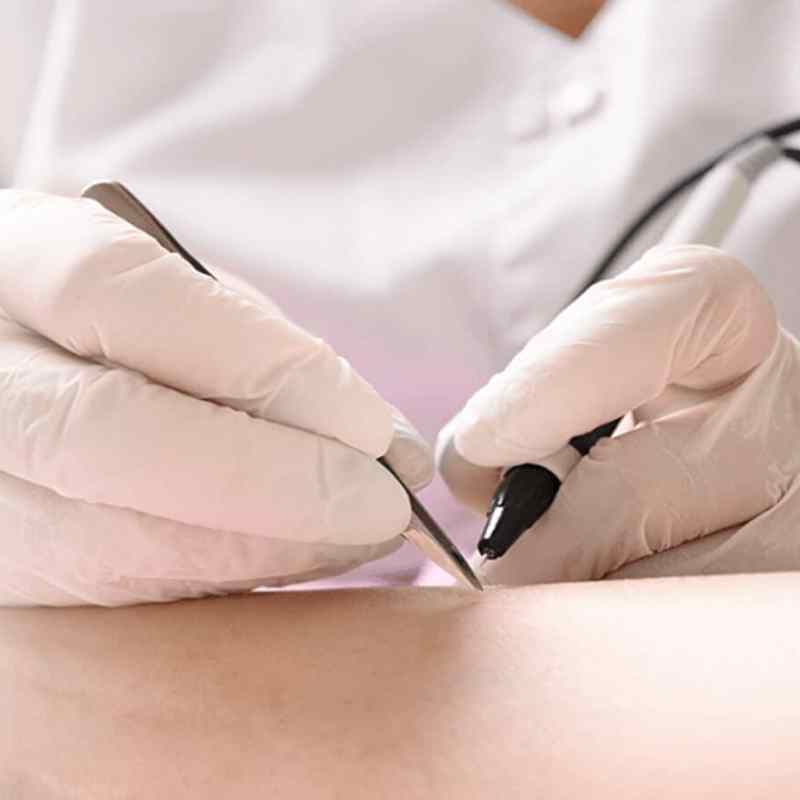 Electrolysis vs Laser Hair Removal: Which Is Best for&nbsp;You?