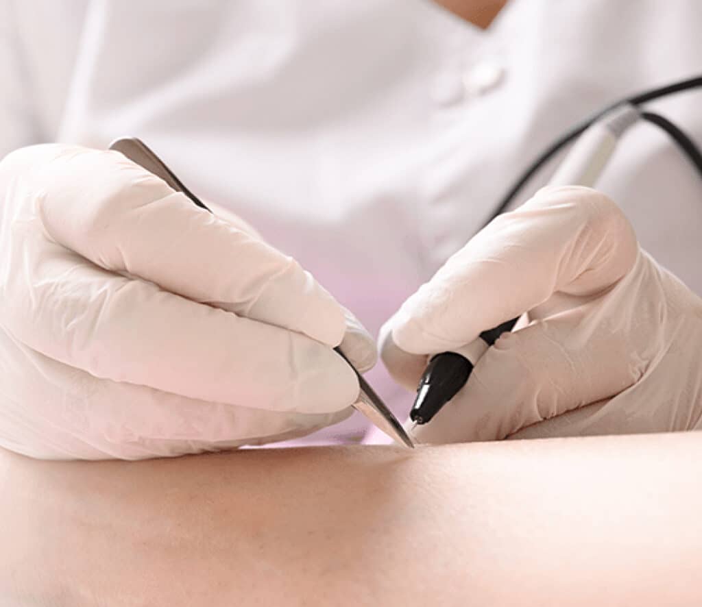 Electrolysis vs Laser Hair Removal: Which Is Best for&nbsp;You?